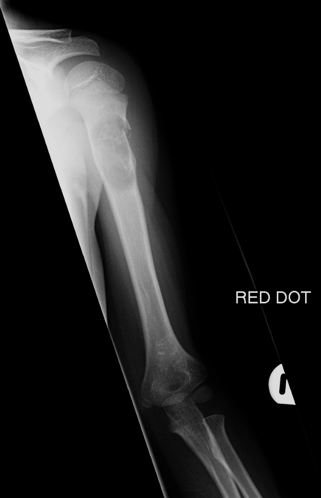 Causes Of Lytic Bone Lesions